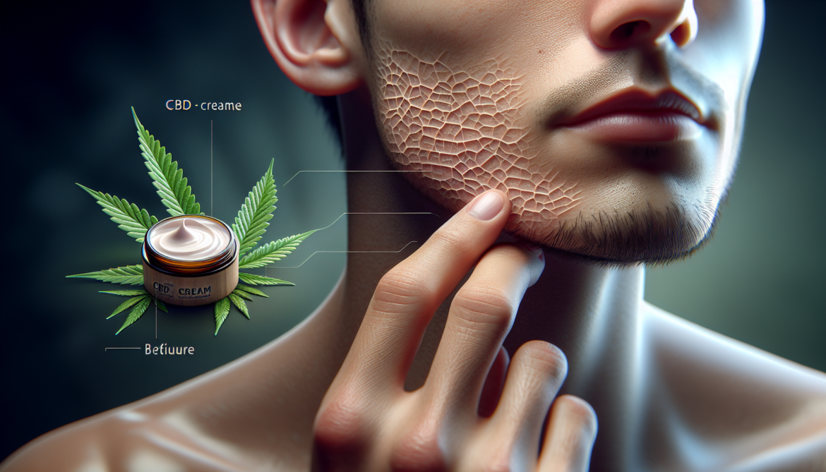 CBD et acné : mon test d’un mois avec une crème au cannabidiol